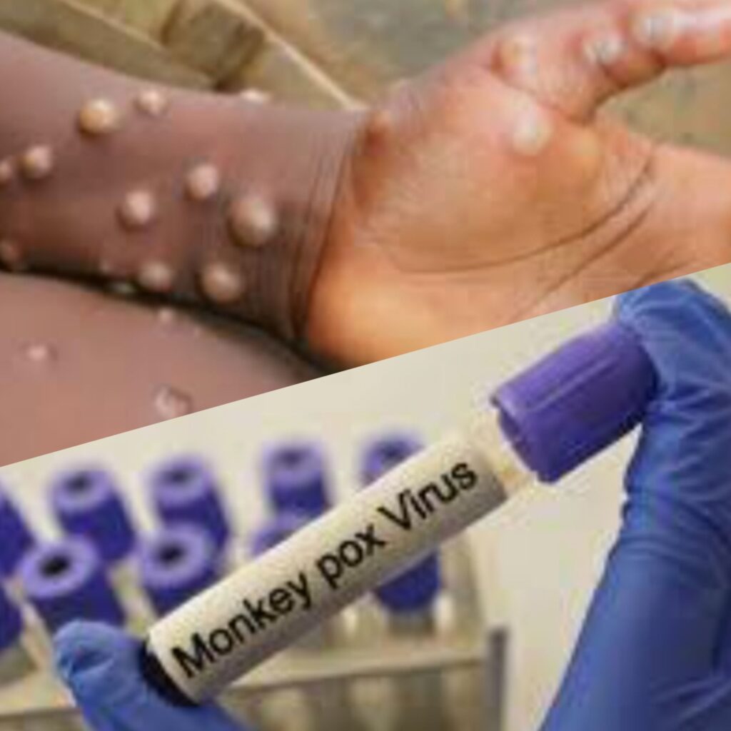 gridart_20250322_2056175648908593238078179400-1024x1024 Watsa/ santé: un cas confirmé de Monkeypox notifié à Watsa