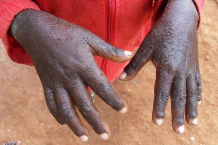 img-20250424-wa01162345251517642604509 Nord-Kivu : quatre cas suspects de fièvre charbonneuse signalés à Lubero, un décès enregistré