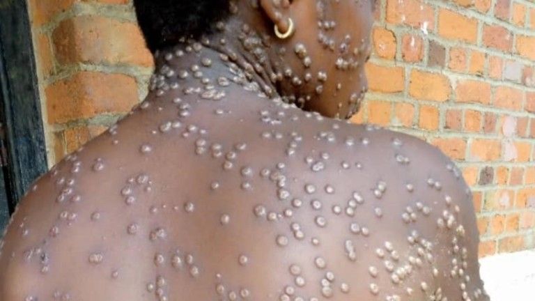img-20250425-wa06438591043530233273010 Ituri : montée des cas de Mpox, le gouverneur tire la sonnette d’alarme