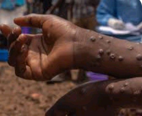 screenshot_20250509-16321622913178613233737639 Haut-Uele : 26 cas suspects et 10 cas confirmés de Mpox enregistrés à Watsa