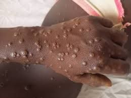 img-20250603-wa01754224473351230322501 Ituri/Mambasa : 4 cas de Mpox confirmés, la population appelée à la vigilance